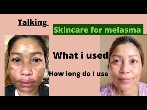 Talking my Skincare for Melasma and Darkspot with Eucerin and how long do I use