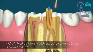 عصب کشی دندان | دندانپزشکی سیمادنت