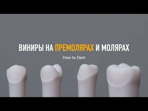 Виниры на премолярах и молярах. VeneerLay