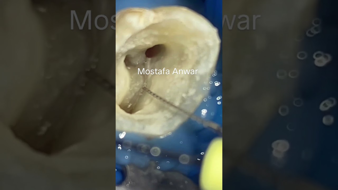 #AnwarEndo  Magnification is very important when it comes to MB2 orifice detection in Upper Molars…