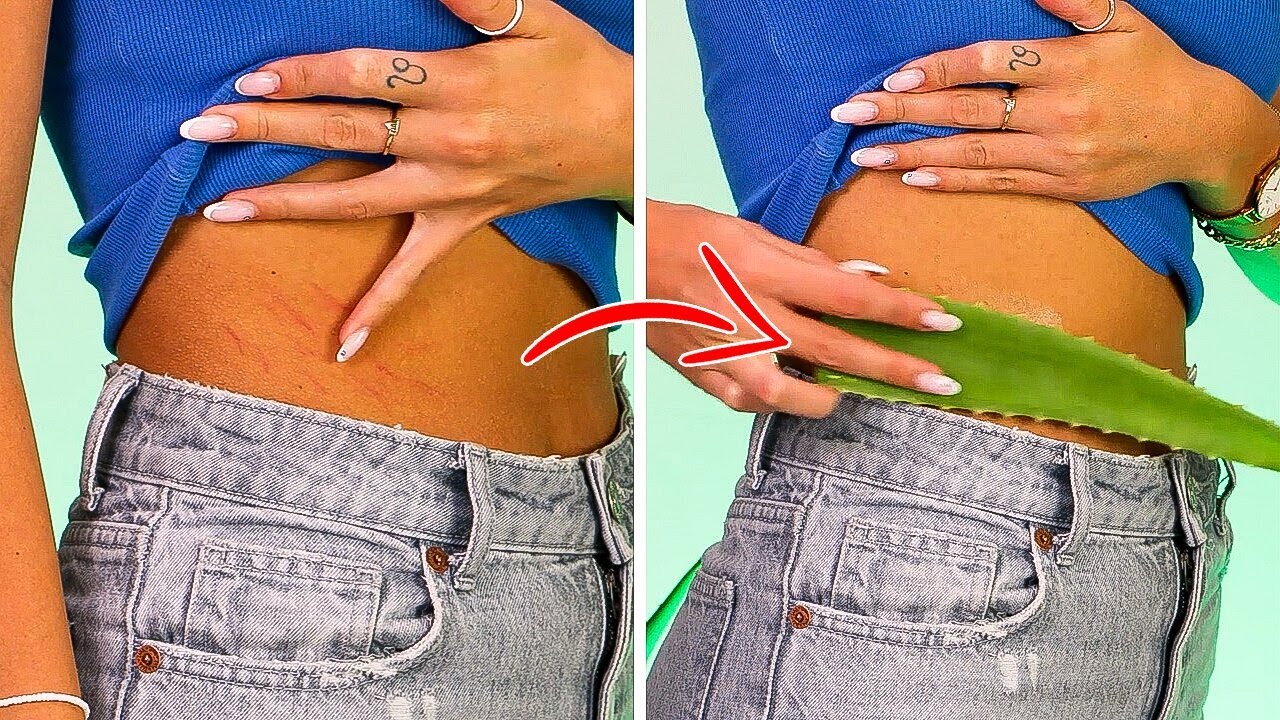 How to Get Rid of STRETCH MARKS with Aloe Vera #shorts