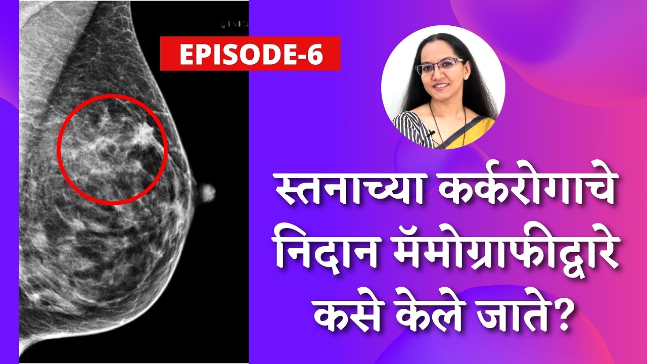 स्तनाच्या कर्करोगाचे निदान मॅमोग्राफीद्वारे कसे केले जाते? जाणून घ्या डॉक्टर काय म्हणतात…