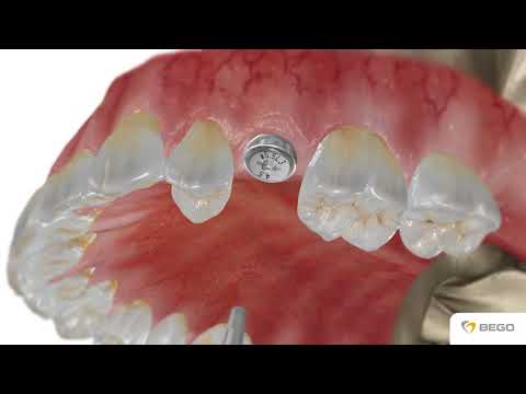 BEGO Semados® RI-Implant