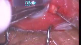 DRAINAGE OF SUPRA CHOROIDAL HAEMORRHAGE