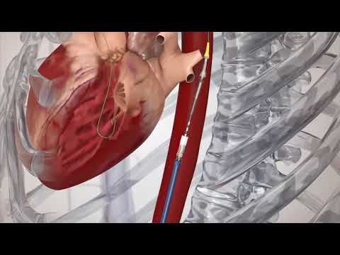 Zoom Webinar: Transcatheter Aortic Valve Replacement | NCH Healthcare System