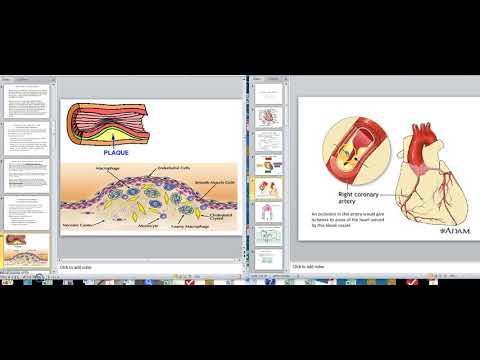 Coronary Artery Disease 1 Ischemia