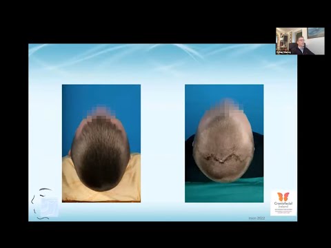 Inion Webinar: Dr. Dylan Murray - Pediatric Cranioplasty with the Inion CPS™ Bioabsorbable Implants