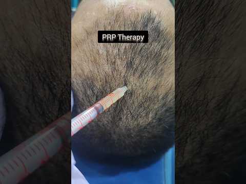 PRP v/s GFC Therapy for Pattern Hair Loss AMAZING Results #prptherapy #gfctherapy #hairlosstreatment