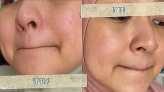 How I got rid of my dry, red patches around my nose