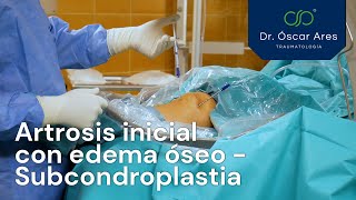 Artrosis inicial con edema óseo - Tratamiento con subcondroplastia - Dr. Oscar Ares