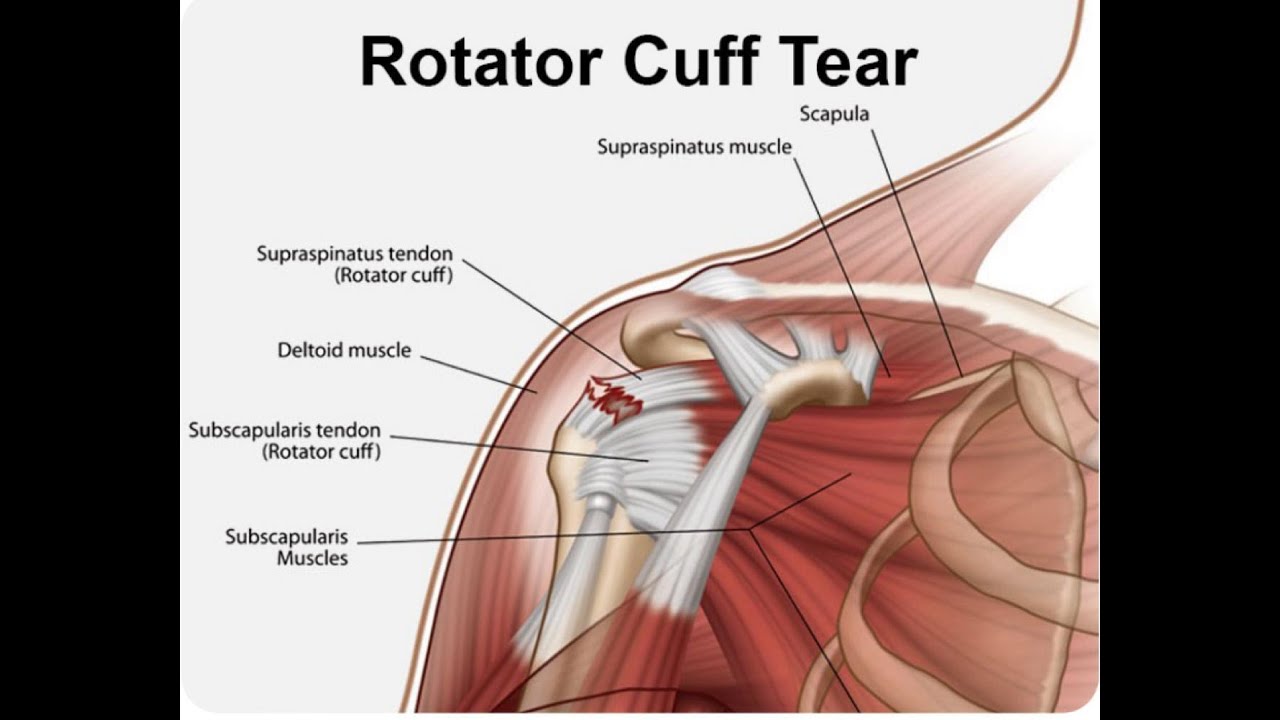 Rotatorcuff injury