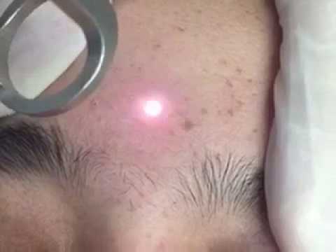 Peeling laser e lentiggini Che togliere macchie scure su una faccia