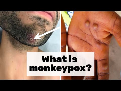What You Need To Know About Monkeypox, According To An Epidemiologist