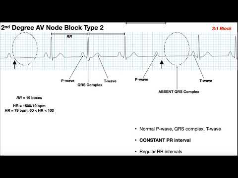 EKG Patterns | 1st & 2nd Degree AV Node Blocks