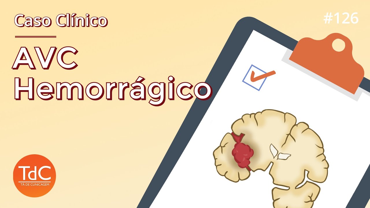 Caso Clínico de AVC Hemorrágico: Episódio 126