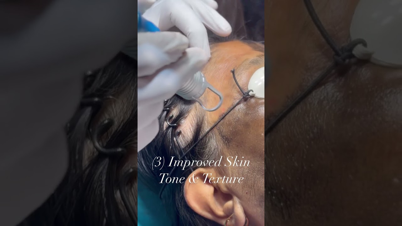 Glowing Skin with Carbon Laser Peel ✨