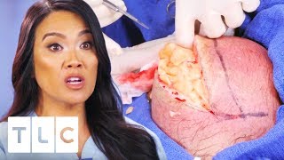 Dr. Lee Removes The Messiest Lipoma Ever! | Dr. Pimple Popper