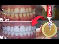 Natural mixture for yellow teeth whitening at home in one day without a dentist, a proven method