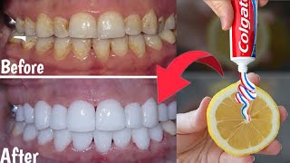 Natural mixture for yellow teeth whitening at home in one day without a dentist, a proven method