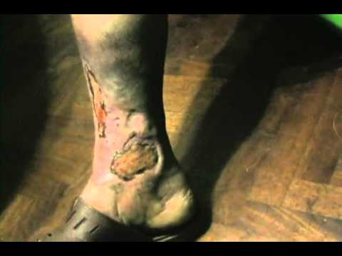 celulitis en el pie tratamiento natural celulitis en el pie tratamiento natural