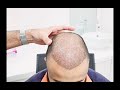 Recovery time after Hair Transplant - ALKHALEEJ DHA