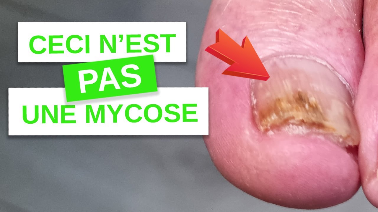 Ceci n'est PAS une Mycose, mais alors quoi  #casclinique