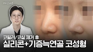 “필러·코실 제거하고 다시 태어났어요” 실리콘+기증늑 코성형 6개월 변화 | 기능코수술 포함 자연스러운 높이감 개선 케이스 리뷰