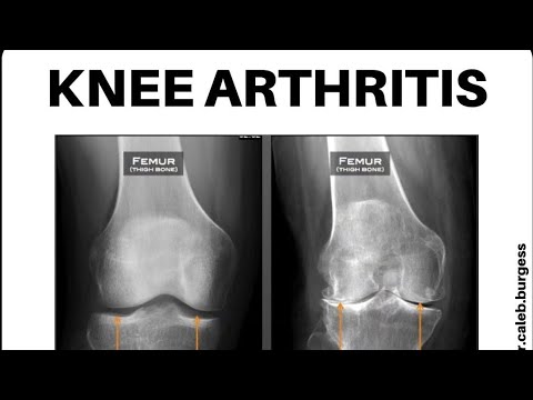 Top 7 Exercises For Knee Arthritis 💥 l PhysioTutor l #kneearthritis #exercises