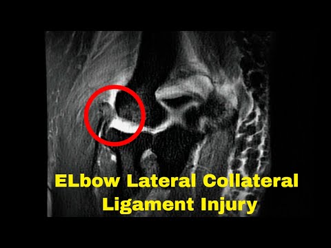 Elbow Lateral Collateral Ligament Injury