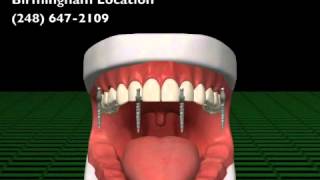 preview picture of video 'Mini Dental Implant Patient Education Video by D.C. Bonadeo DDS'