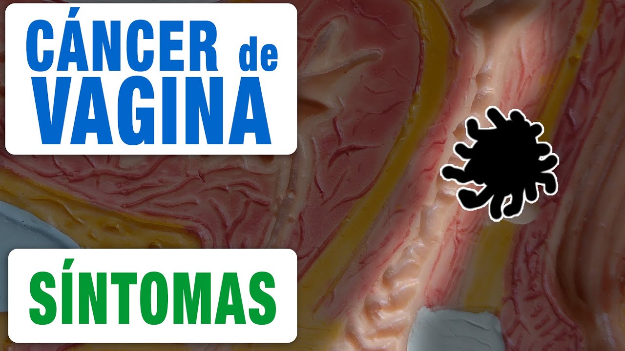 Todos los Síntomas del Cancer de Vagina