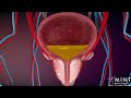 Prostate Artery Embolization (PAE) video