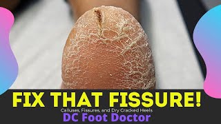 Fix That Fissure!: Calluses, Dry Skin, and A Deep Crack In The Heel