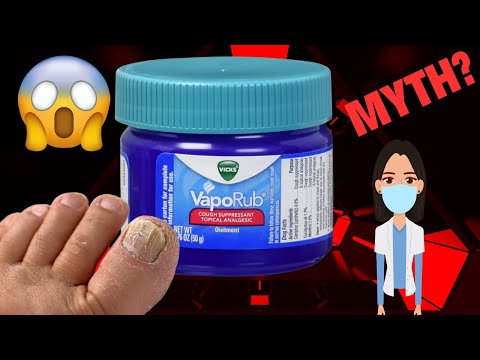 VICKS VAPORUB GEGEN ZEHENNAGELPILZ: Mythos oder Zauberei?