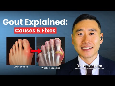 How To Stop Gout Attacks For Good | Doctor Explains Long-Term Gout Fix