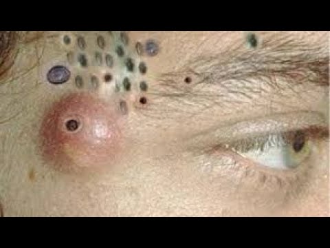 THE BEST BLACK HEADS 2025 ❤️❤️