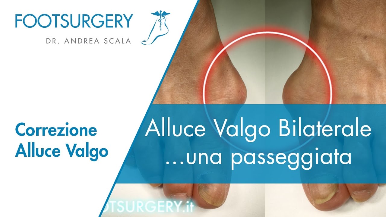 Alluce Valgo Bilaterale, una passeggiata | Alluce valgo prima e dopo intervento | Dott. Andrea Scala