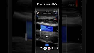 How To Scan in Color Doppler | Butterfly Network