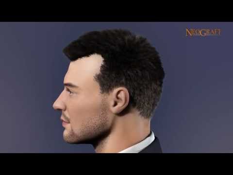 NeoGraft Hair Transplant System Explained  Follicular Unit Extraction FUE
