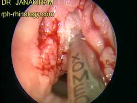 Laryngeal papillomatosis surgery