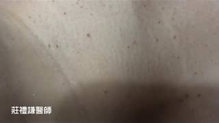 [問題] 請推薦台中除肉芽的醫美皮膚科診所