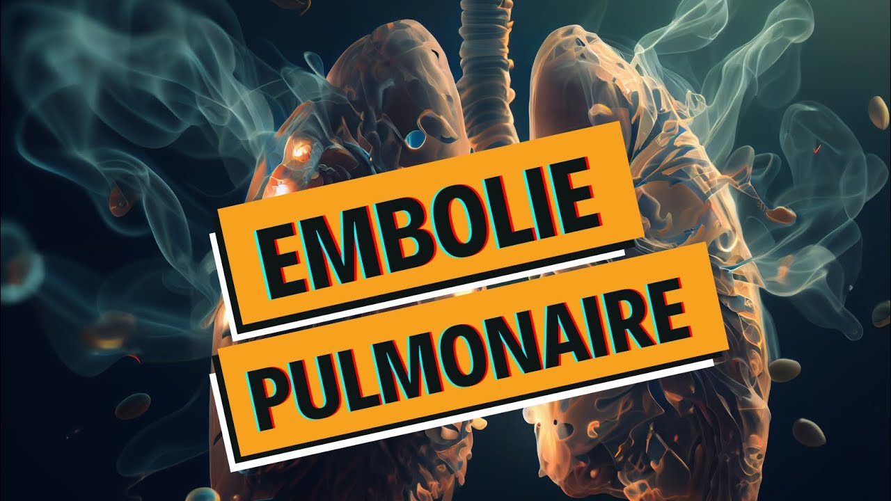 EMBOLIE PULMONAIRE et PHLEBITE : tout comprendre - WhyDoc #1