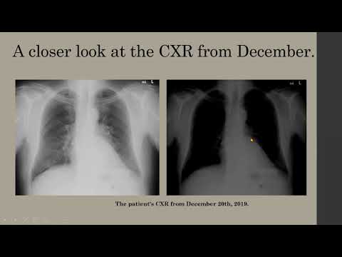 A missed, uncommon lesion on a chest radiograph