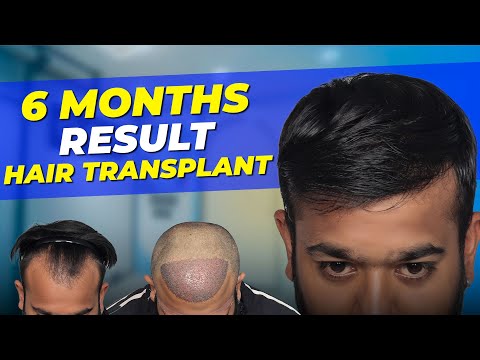 Hair Transplant in Bangalore | Best Results & Cost of...