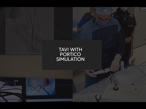 TAVI with Portico Simulation