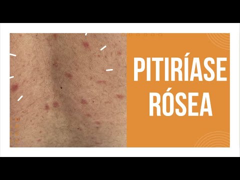PITIRÍASE RÓSEA