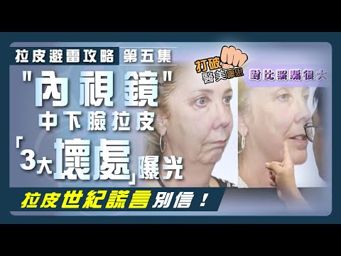 【拉皮避雷攻略|第五集】別被神化的"內視鏡"拉皮誤導! 拉皮權威曝內視鏡中下臉拉皮手術「3大壞處」 拉皮前不看會後悔