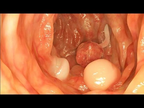Mayo Clinic Minute: Colonoscopy
