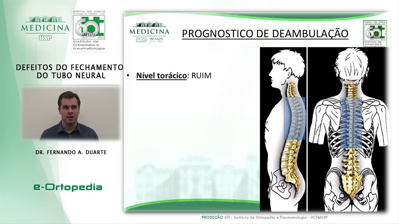 Defeito do Fechamento do Tubo Neural - Dr. Fernando A. Duarte