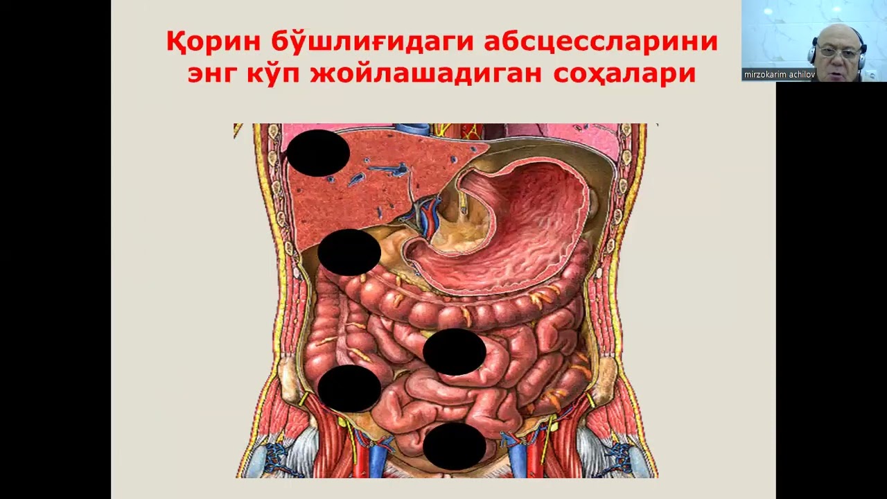 O'tkir appenditsit asoratlari